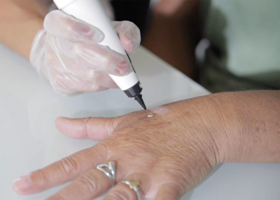 Handheld cryotherapy device being applied to a small skin lesion on a hand